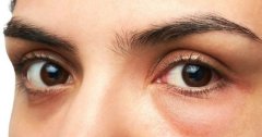 13 nguyên nhân gây bọng mắt và cách khắc phục nhanh