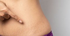 14 cách trị rạn da lâu năm tại nhà đơn giản, nhanh hiệu quả nhất
