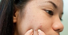 Bí quyết chăm sóc da mụn mà chưa chắc ai cũng biết