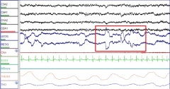 Polysomnography là gì và những điều bạn chưa biết về đa ký giấc ngủ