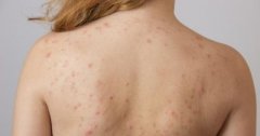 Trị mụn lưng như thế nào hiệu quả dùng sản phẩm gì tốt nhất?