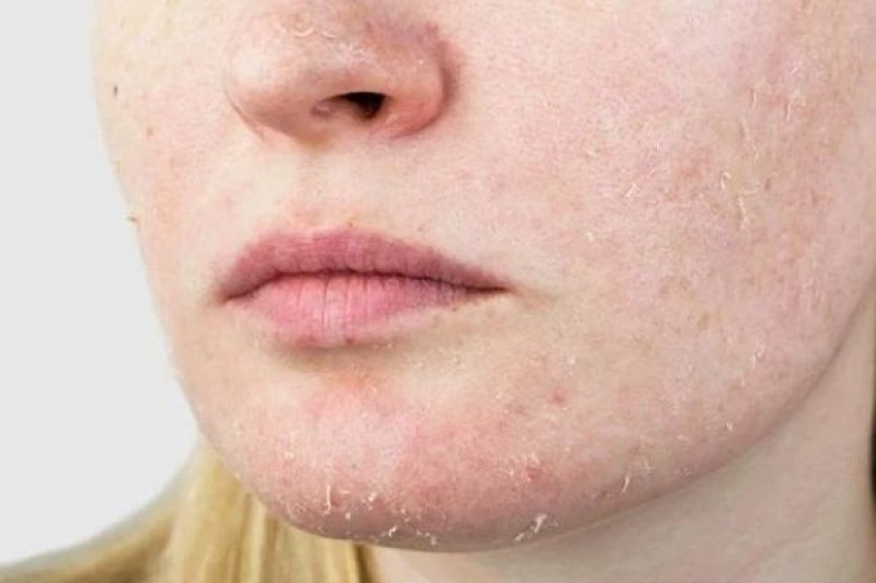 Các bước chăm sóc da khô để da căng bóng khỏe mạnh tự nhiên 1