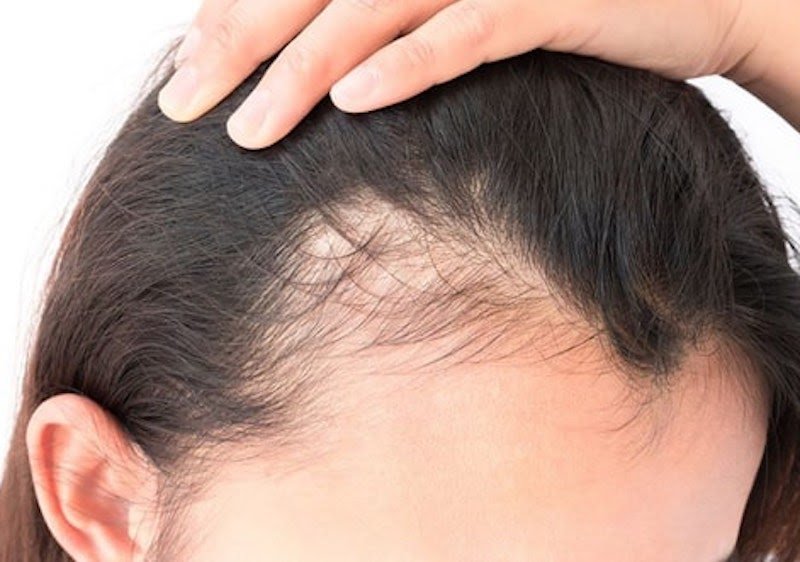 Có nên cấy tóc tự thân trị hói đầu không? 5