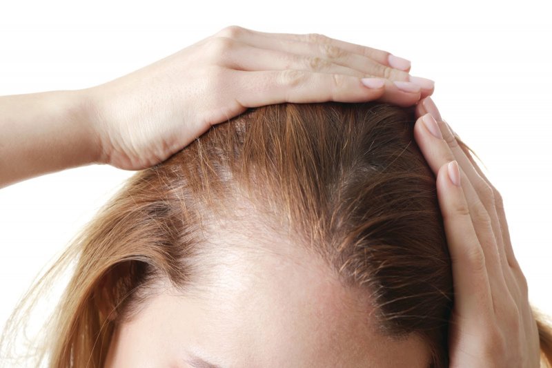 Có nên cấy tóc tự thân trị hói đầu không? 8